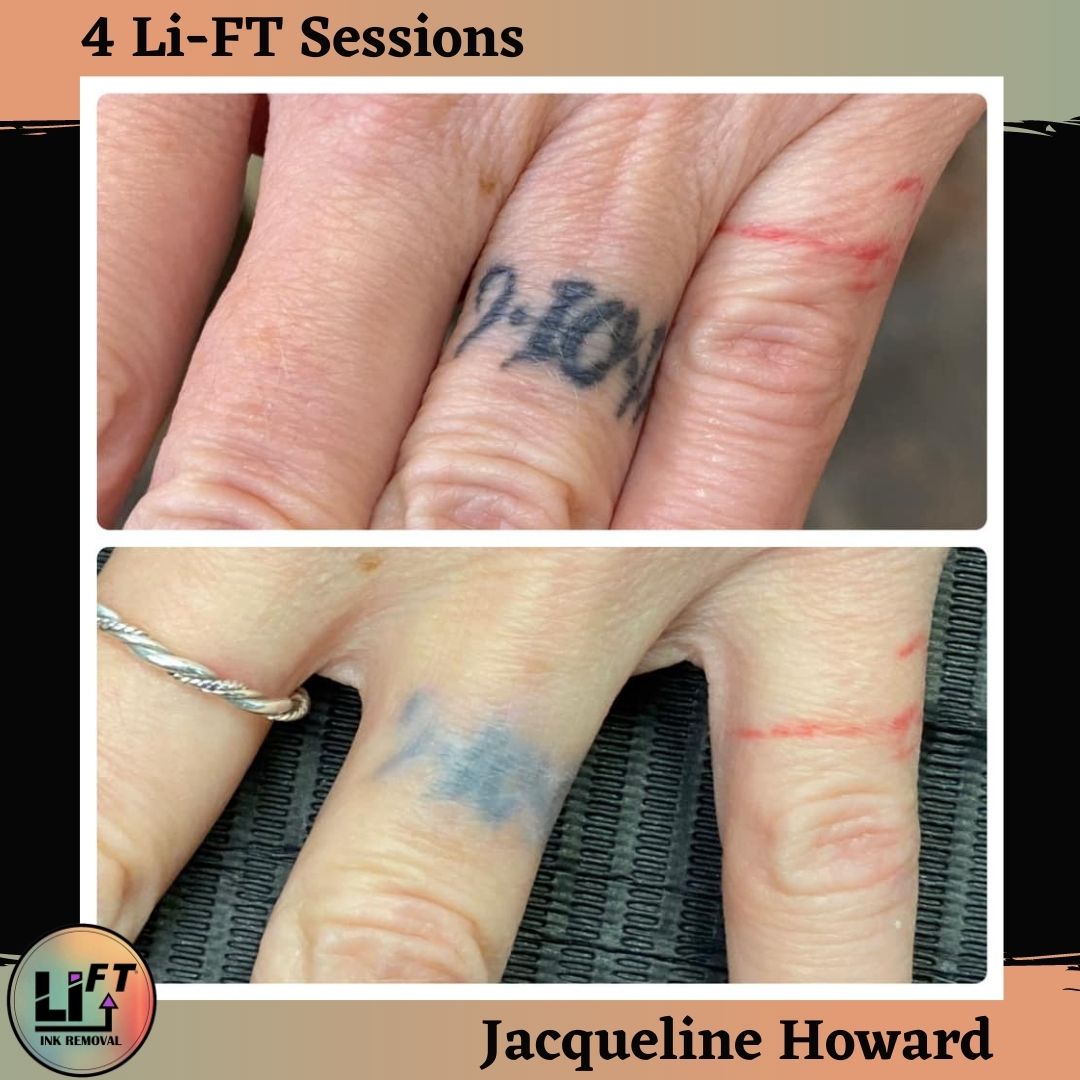 LiFT Online Training UK Students  Ink Removal Training  Body and  Brows by Alice Kingdom