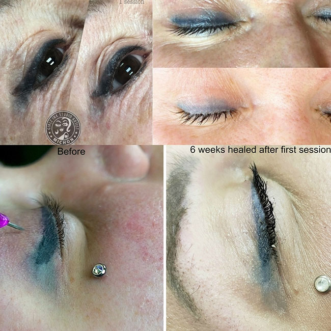 How to remove permanent eye liner using the Picoway laser  YouTube